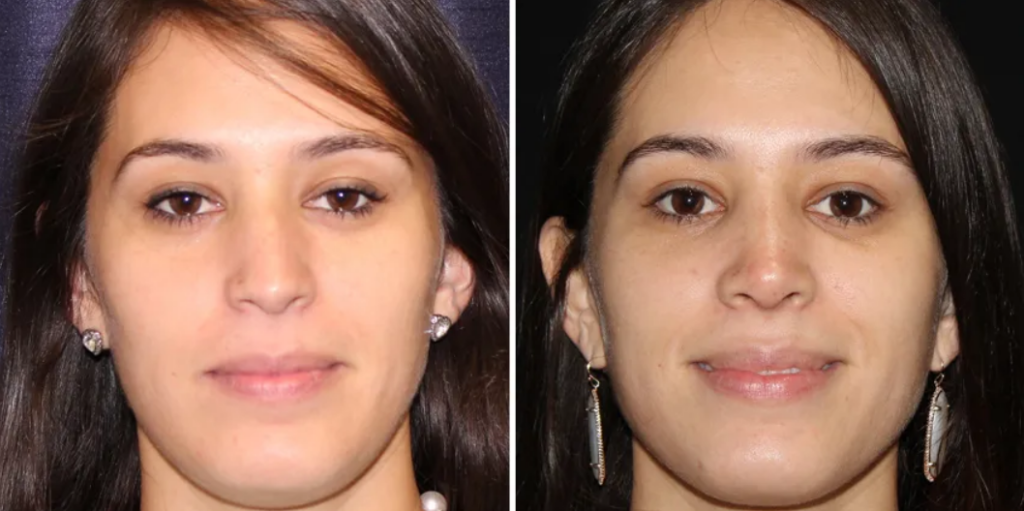 types of nose surgery to breathe better