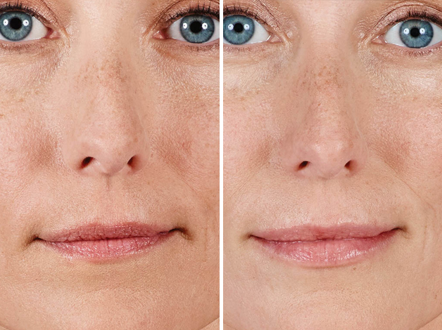 Clinique Dallas Juvederm Ultra XC