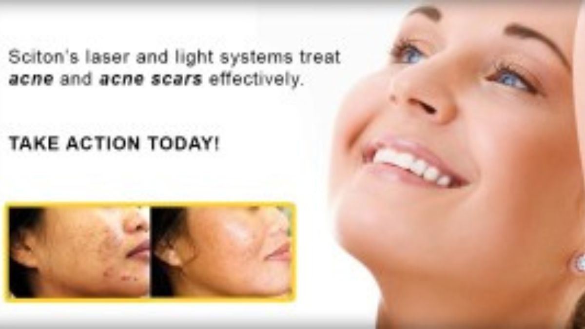 BBL Acne Therapy - Plastic Surgery, Medspa and Laser Center | Clinique Dallas