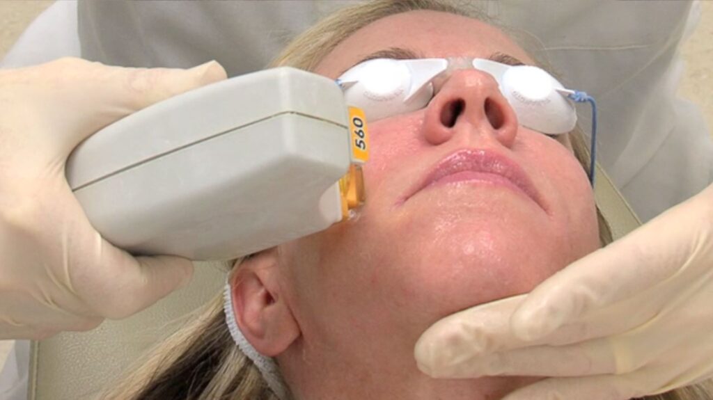 Acne Case - BBL Acne Therapy - Plastic Surgery, Medspa and Laser Center | Clinique Dallas