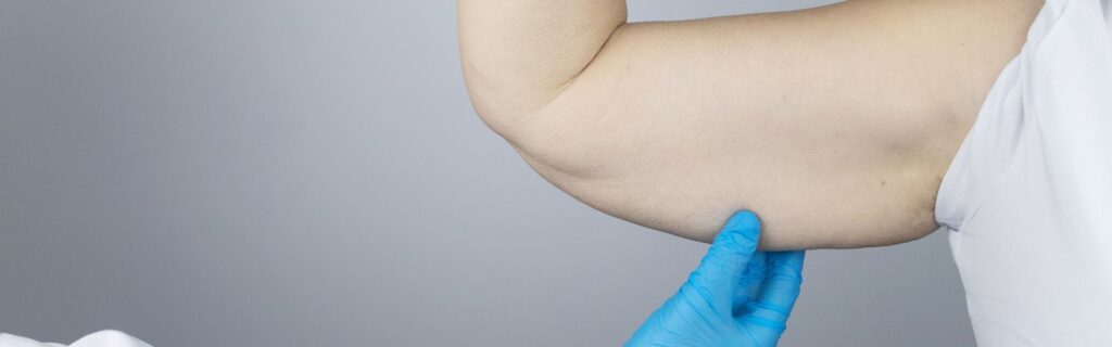 brachioplasty vs liposuction