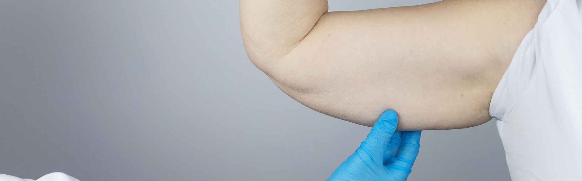 brachioplasty vs liposuction