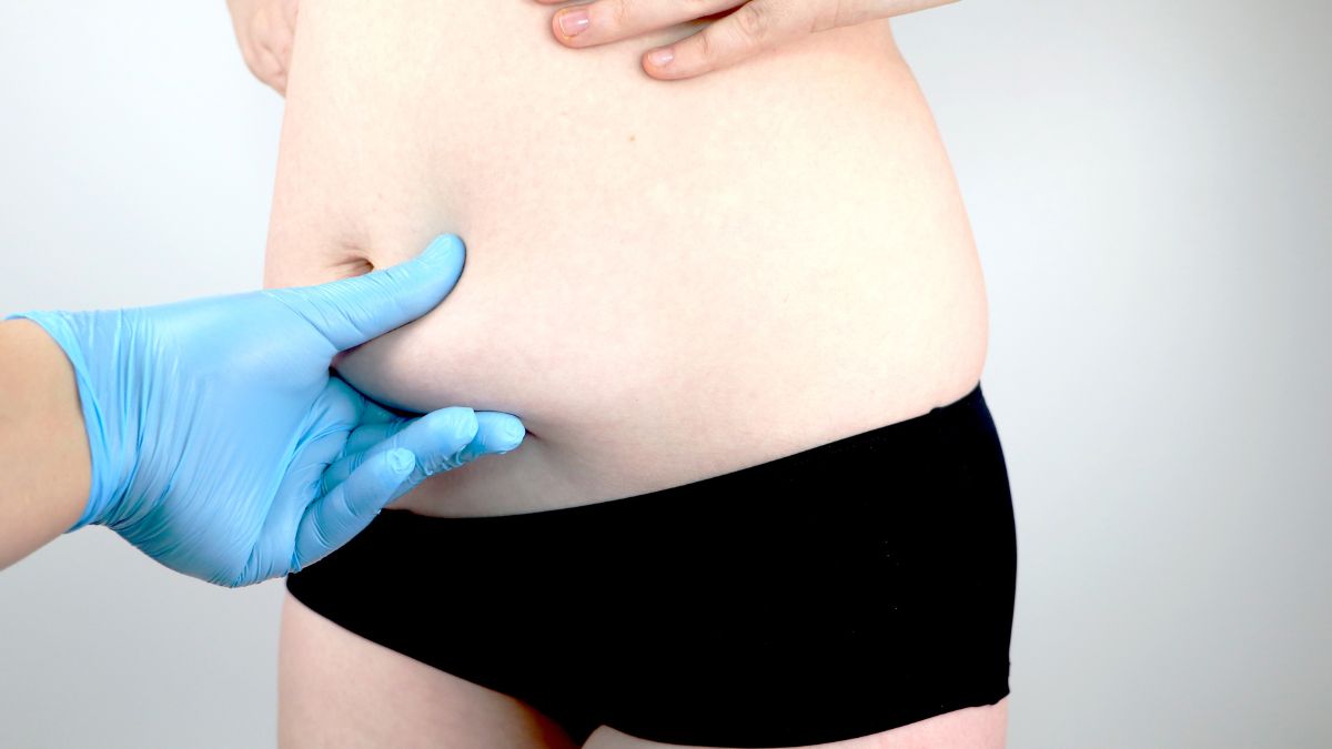 Where Can You Get Liposuction?