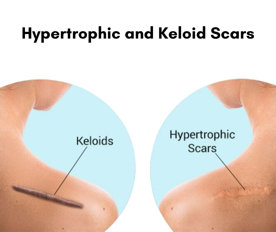 Types of Acne Scars and How to Treat Them Clinique Dallas Plastic